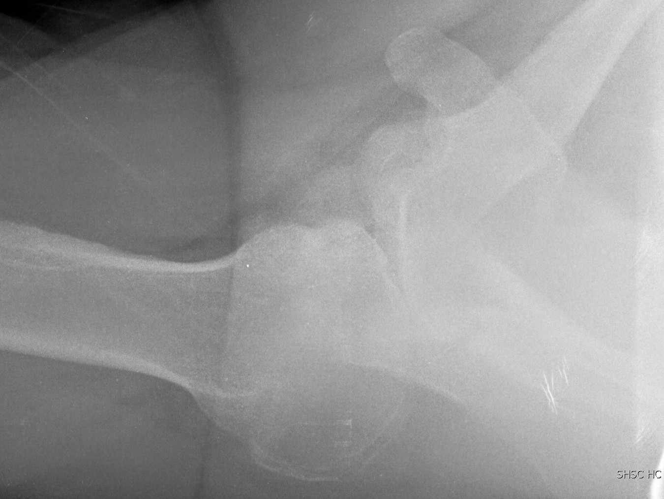 Axillary Lateral Posterior Subluxation